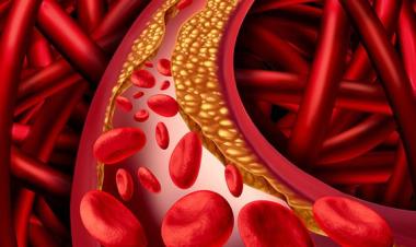 5 Buah Penurun Kolesterol Tinggi yang Perlu Dikonsumsi Secara Rutin